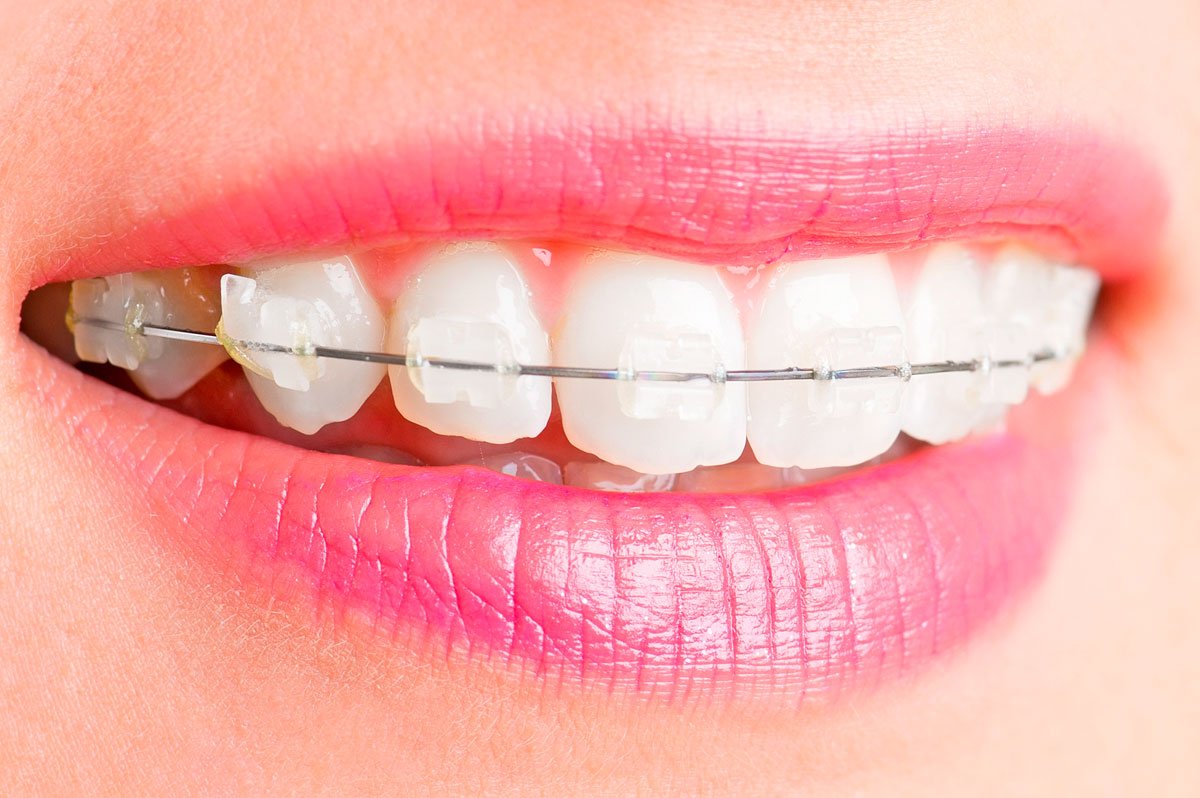 Ortodoncia - Brackets Estéticos Cerámicos | Santa Perpetua Clinica Dental