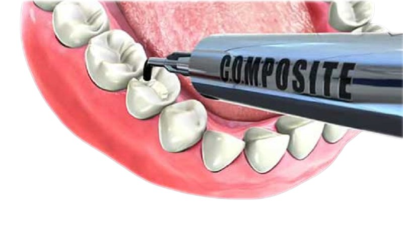 Composite - Tratamiento Caries y estética dental | Santa Perpetua Clínica Dental
