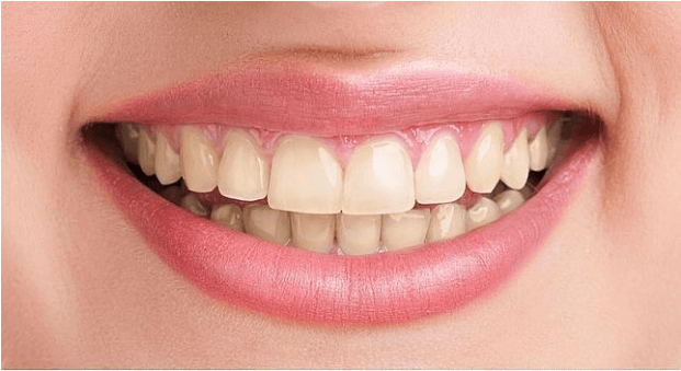 Blanqueamiento dental | Santa Perpètua Clínica Dental